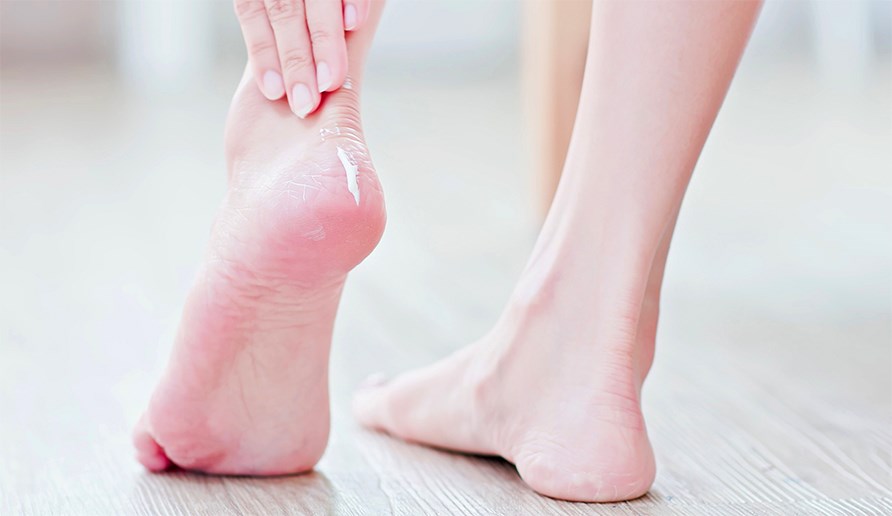 H�nd, der sm�rer t�rre f�dder med fodcreme.